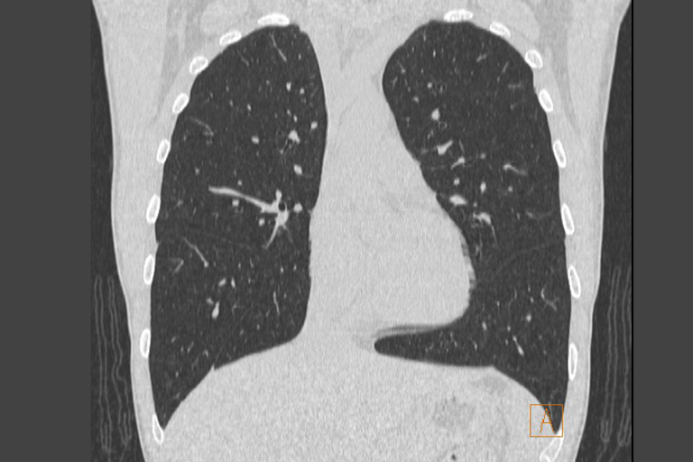 写真：肺がんCT検査