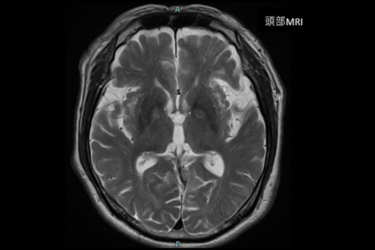 写真：頭部MRI画像